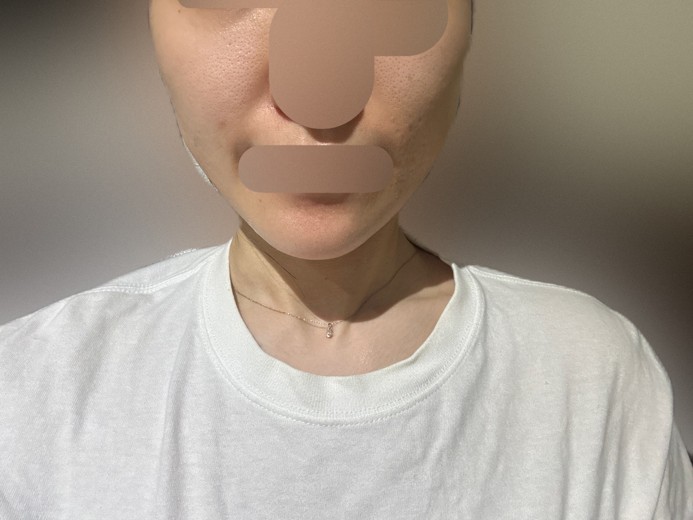 after photo: エレクトロポレーション