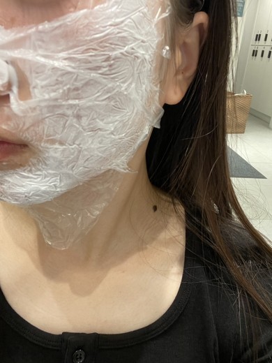 before photo: PDTレーザー, フラクショナルレーザー, レーザートーニング, ほくろ除去(レーザー)