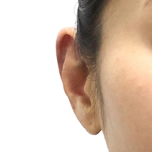 after photo: 귓볼필러