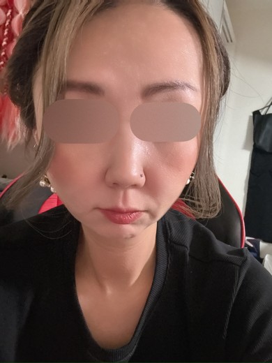 before photo: ダーマペン