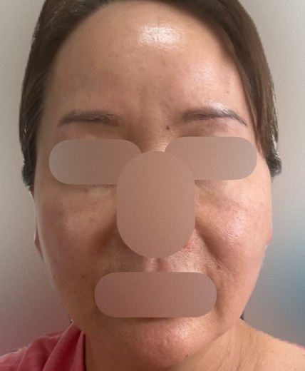 before photo: ダーマペン