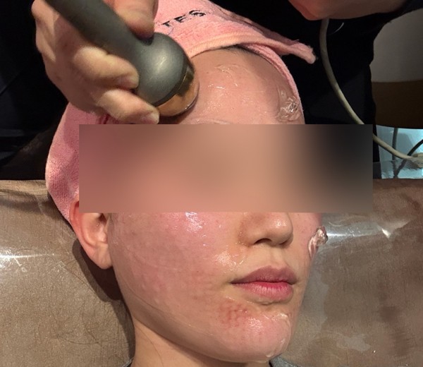 after photo: 리쥬란힐러