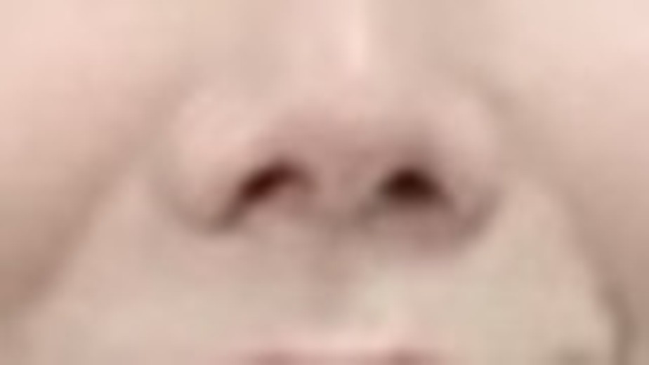 before photo: 실리프팅, 팔자주름필러