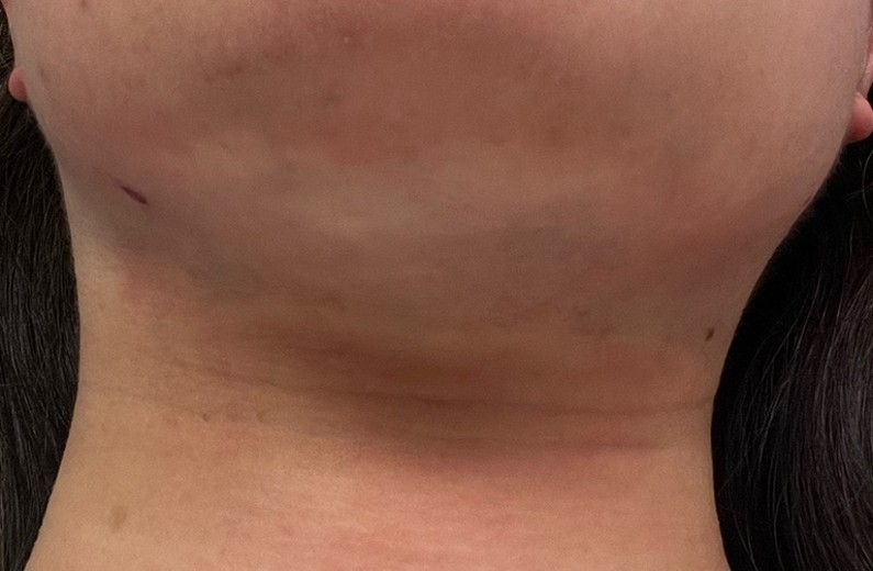 after photo: 脂肪吸引注射