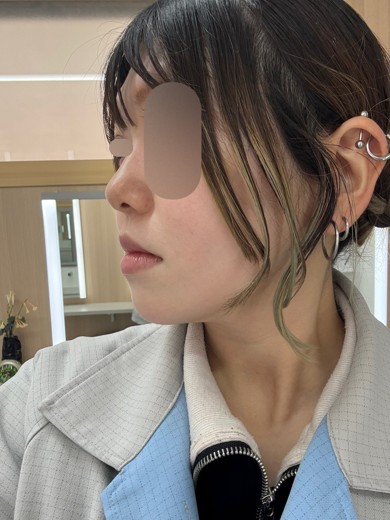 after photo: 糸リフト, 脂肪吸引(顎下), 脂肪吸引(顔), 脂肪吸引(頬)