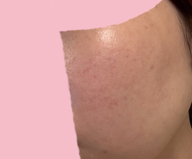 after photo: IPL(光/フォト治療), ルメッカ
