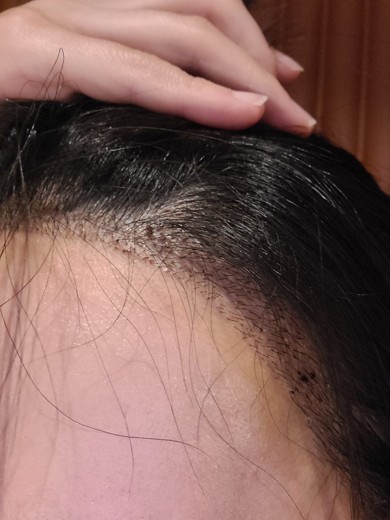 after photo: 머리모발이식