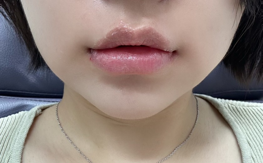 after photo: 입꼬리필러, 입술필러