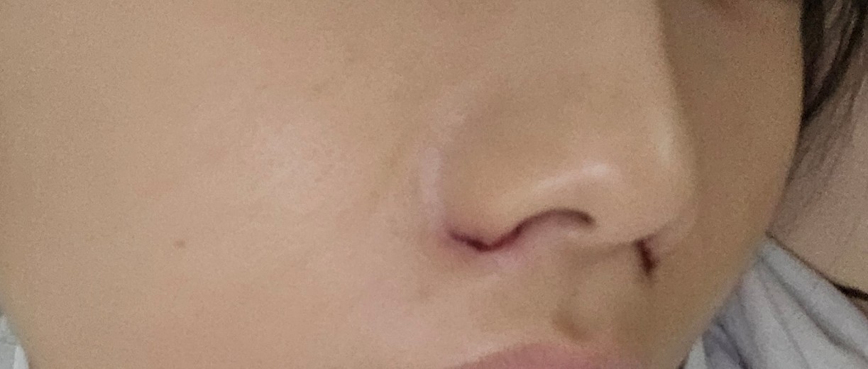 after photo: 콧볼축소