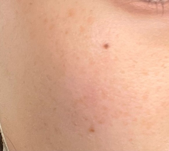 before photo: IPL(光/フォト治療), ピーリング, ルメッカ