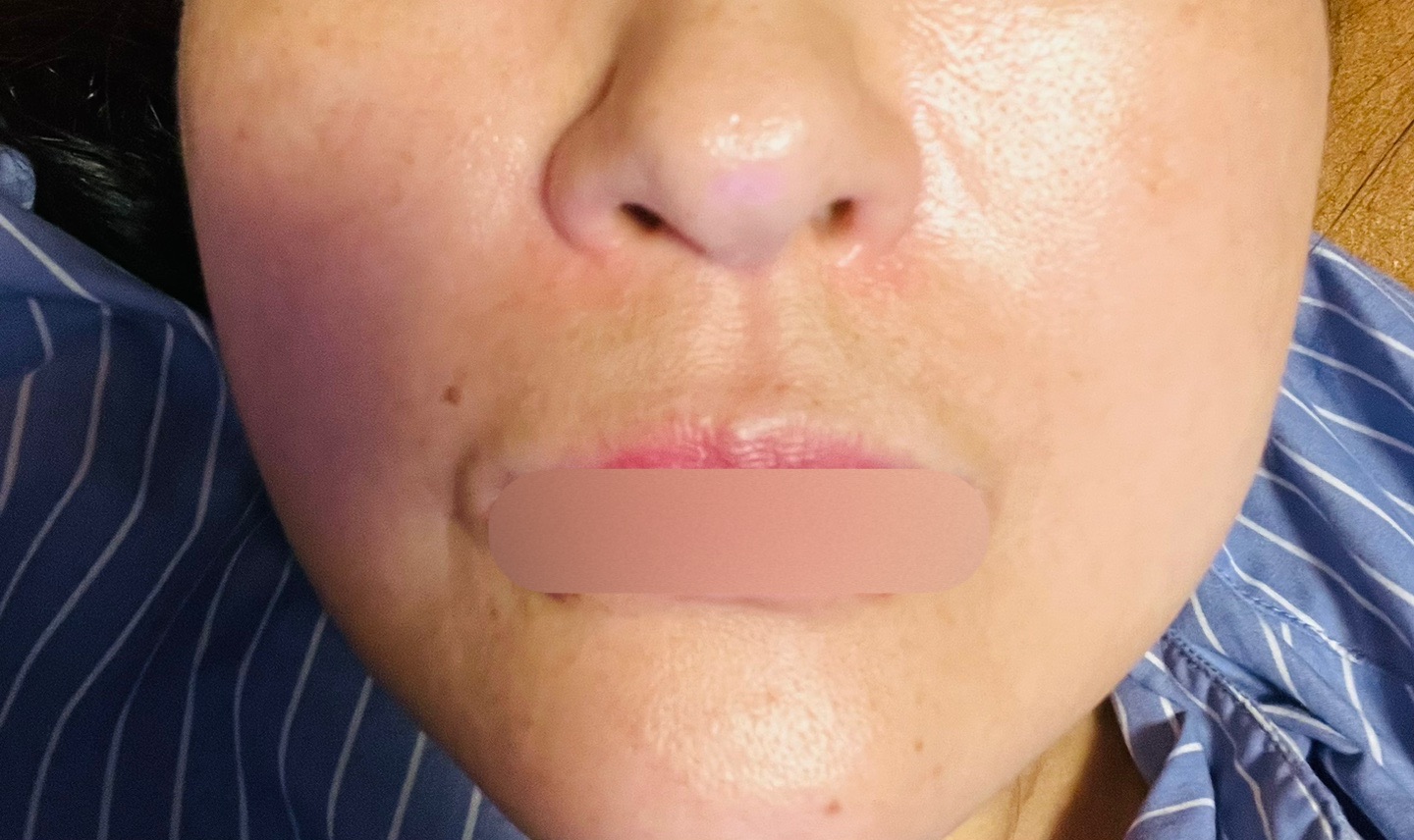 イタリア製 ♧ 口顎首のEx-voto ポテンツァ ダイヤモンドチップ（全顔300ショット）たるみ・引き締めに