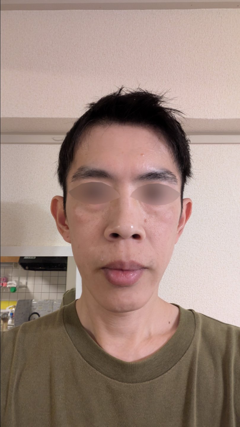 全顔シミ取り放題＋美顔レーザートーニング【12月29日迄にご予約頂いた