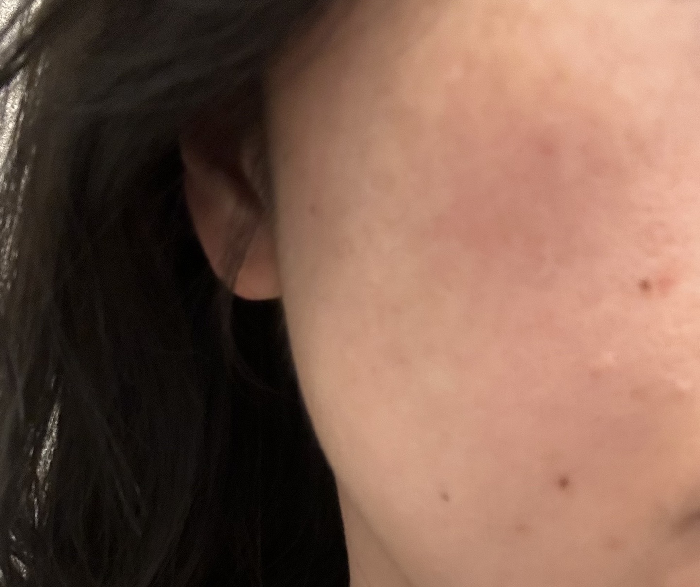 マッサージピール｜即日ハリ・ツヤ・透明感美肌治療【1月15日迄にご