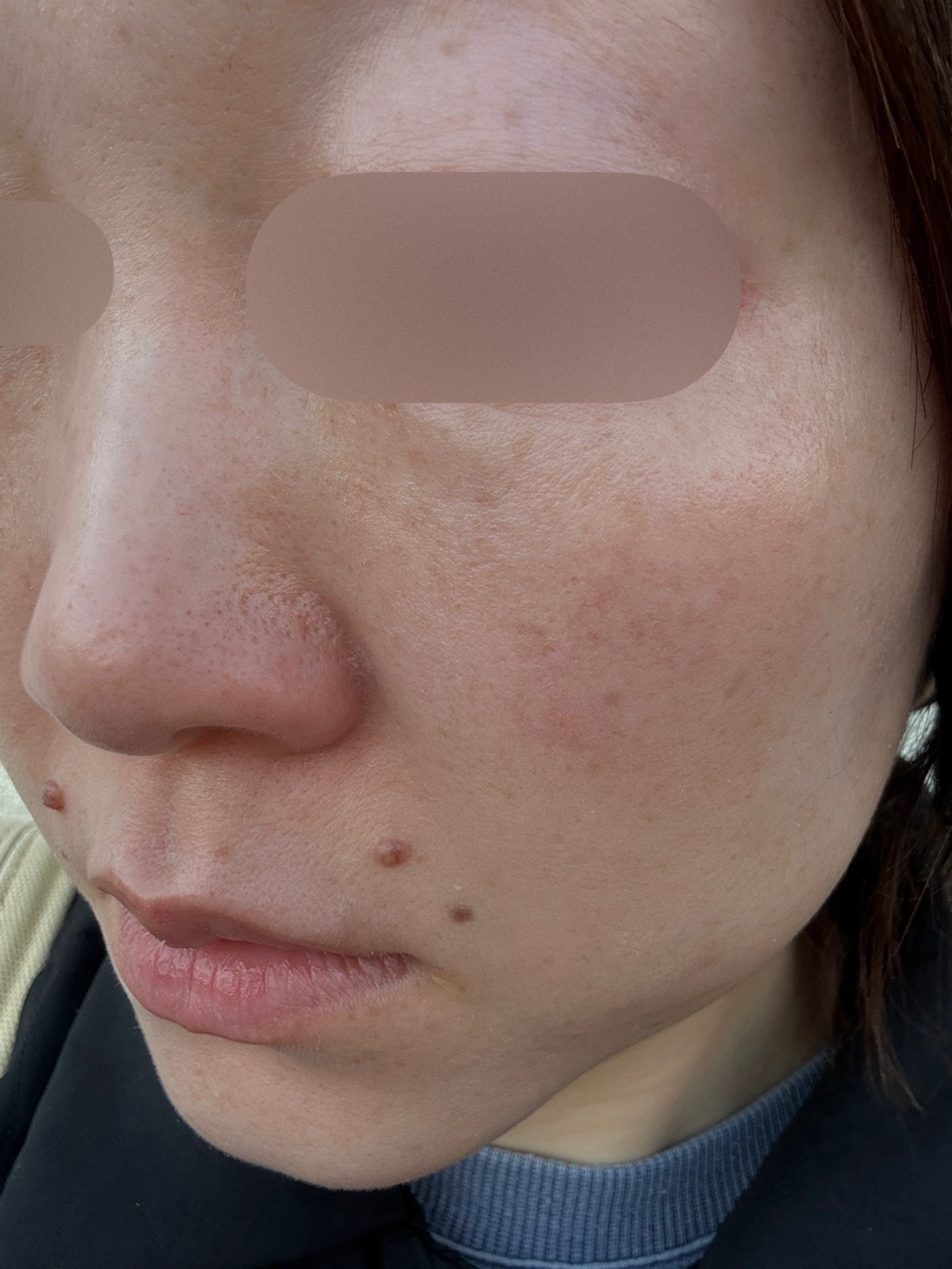 ピコトーニング＋マッサージピール【3月15日迄にご予約頂いた方】 | ZX