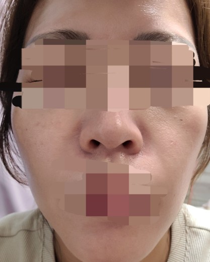 after photo: ハイドラフェイシャル, 診断・検査