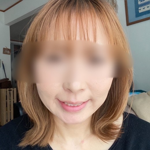 before photo: 脂肪溶解注射(顔)