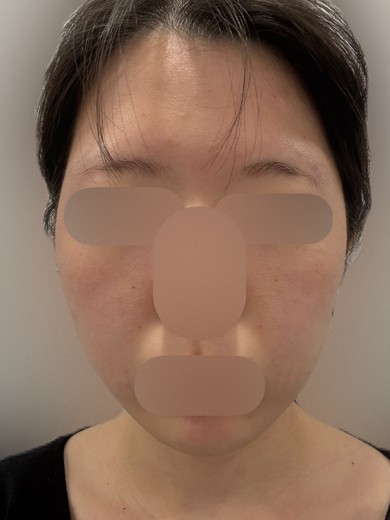 after photo: 슈링크유니버스