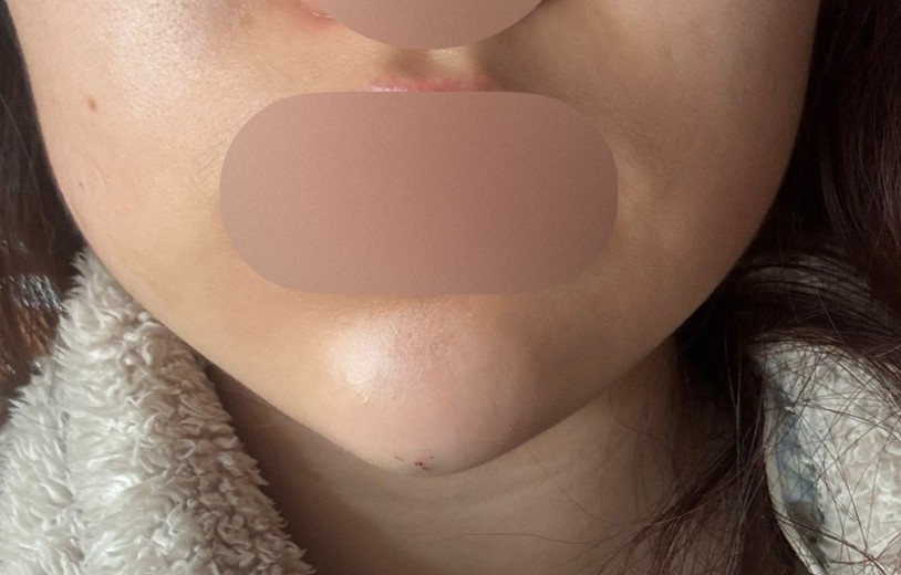 after photo: 턱끝필러