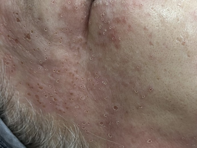 after photo: 어븀프락셀, 클라리티