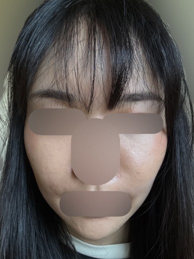 after photo: サーモン注射