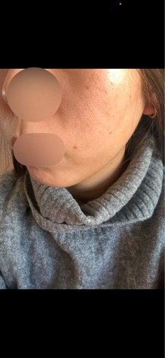 before photo: レーザーフェイシャル