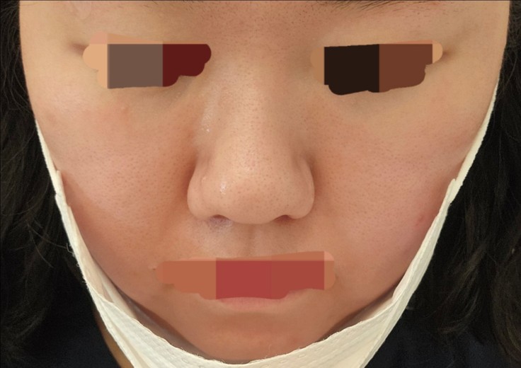 after photo: 아쿠아필링