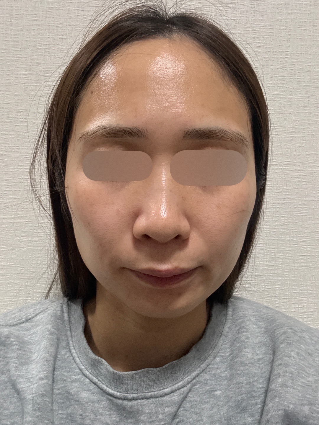 初診限定】ララピール（全顔）＋エレクトロポレーション | 心斎橋KT