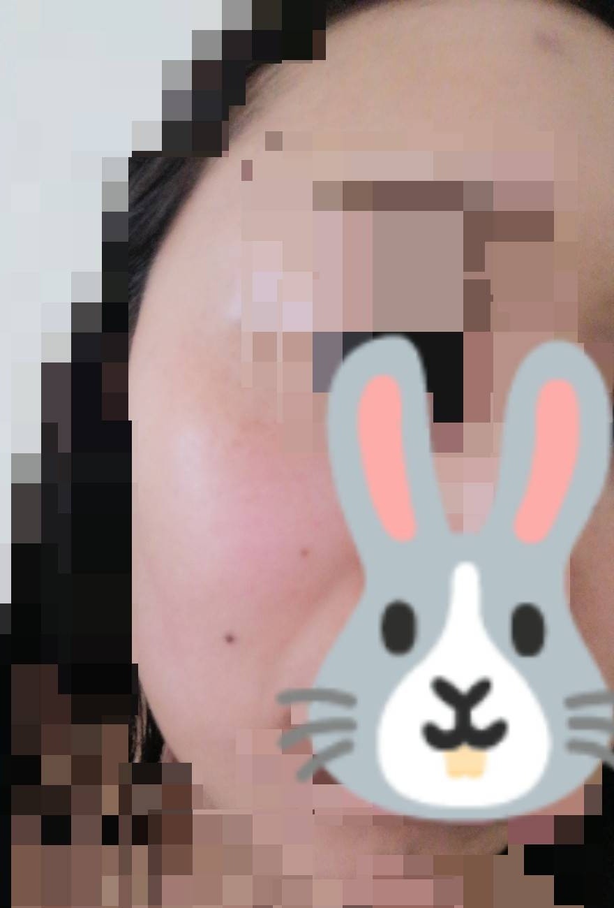何度でも可】ピコトーニング全顔｜薄いシミ・くすみ・肌質改善 | ZX