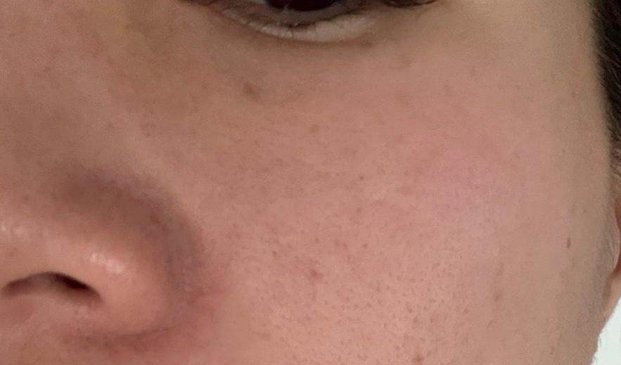 before photo: サーモン注射
