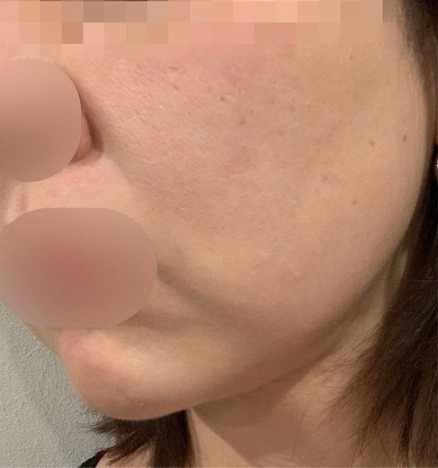 after photo: エレクトロポレーション, ハイフ(HIFU)