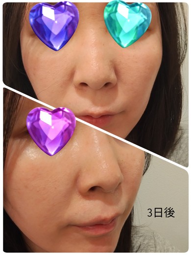 after photo: ピーリング, ダーマペン