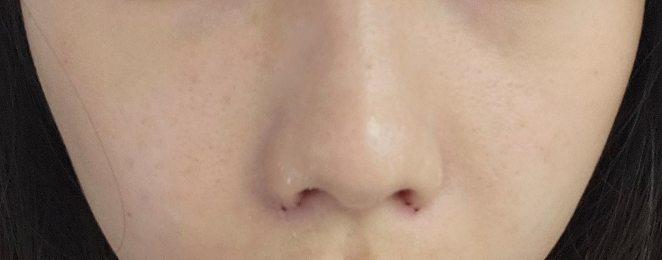 after photo: 콧볼축소