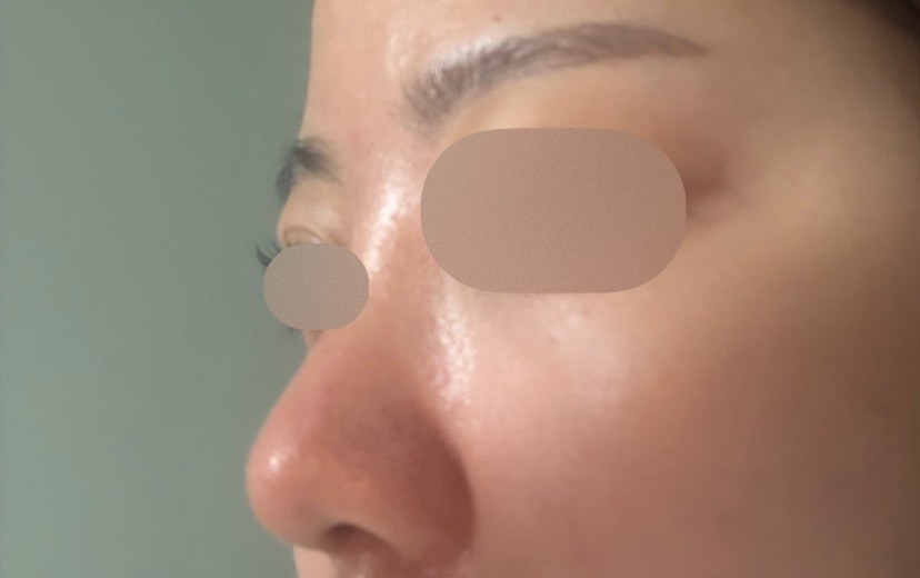 after photo: 콧대(보형물), 코끝(자가연골), 복코교정(수술)