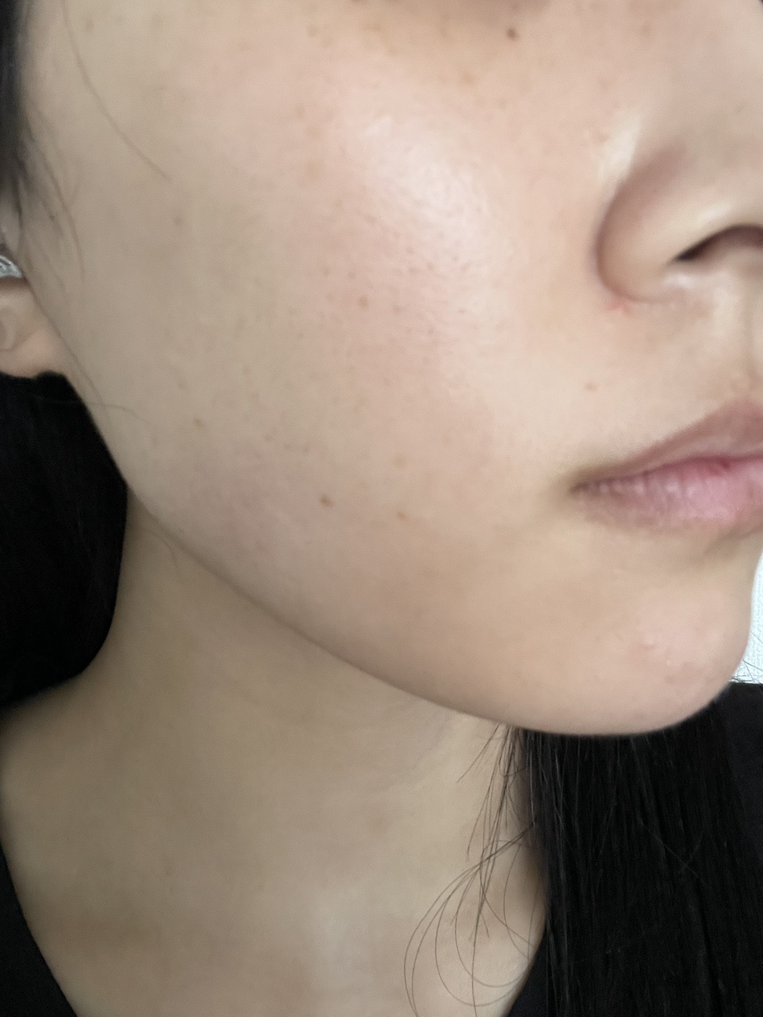 ピーリング　エレクトロポレーション エレクトロポレーション（イオン導入）｜美容皮膚科なら湘南美容