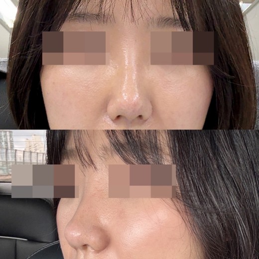 after photo: 콧볼축소