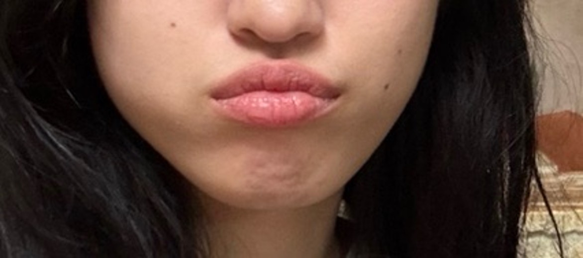 before photo: 사각턱보톡스, 슈링크유니버스