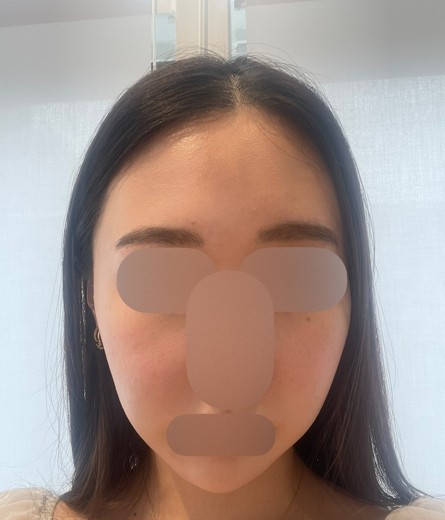 before photo: ピコスポット