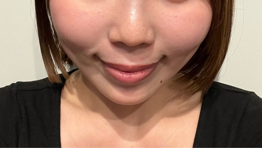 after photo: 脂肪溶解注射(顔)