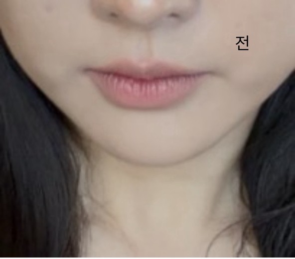 before photo: 입술필러