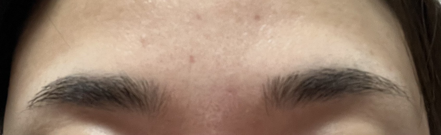 after photo: 사각턱보톡스