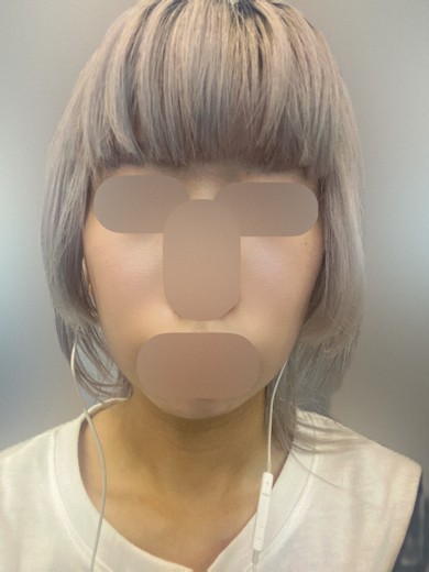 before photo: 首・広頚筋ボトックス