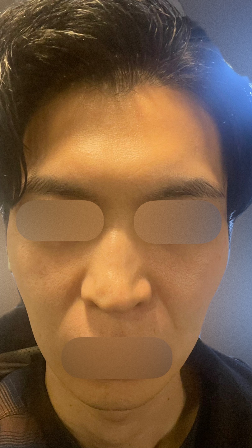 何度でも可】【男性限定】ヒゲ脱毛（髭全体）｜ジェントルマックスプロ