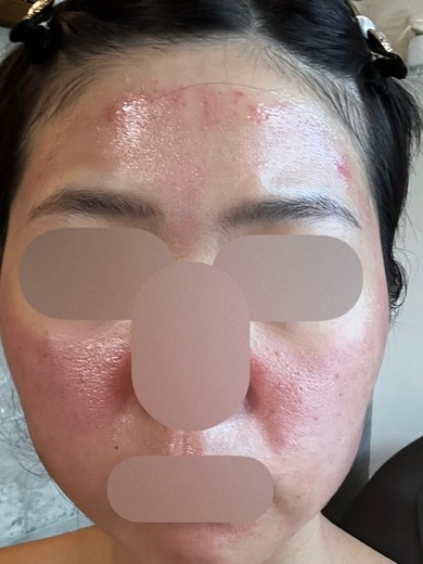 after photo: ダーマペン