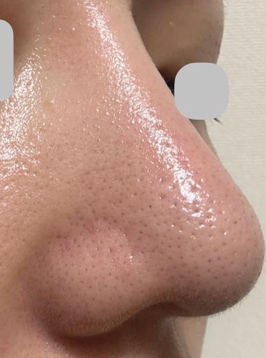 after photo: ハイドラジェントル