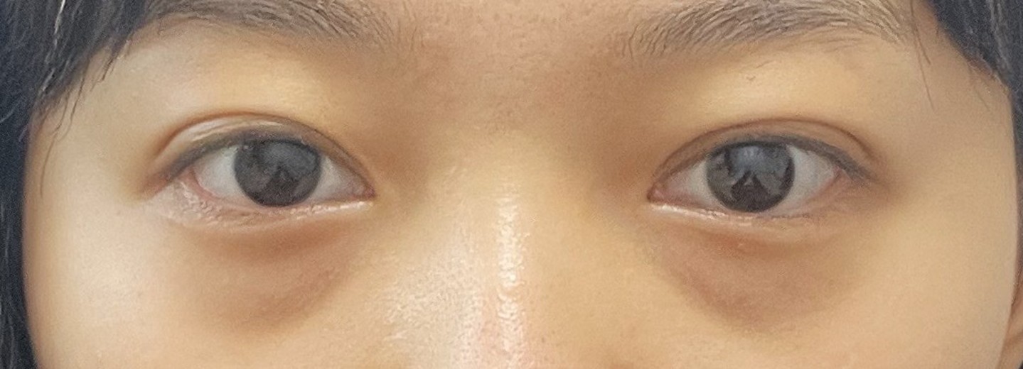 before photo: 눈밑지방재배치