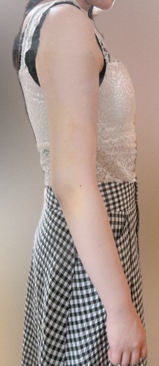after photo: 脂肪吸引(腕)