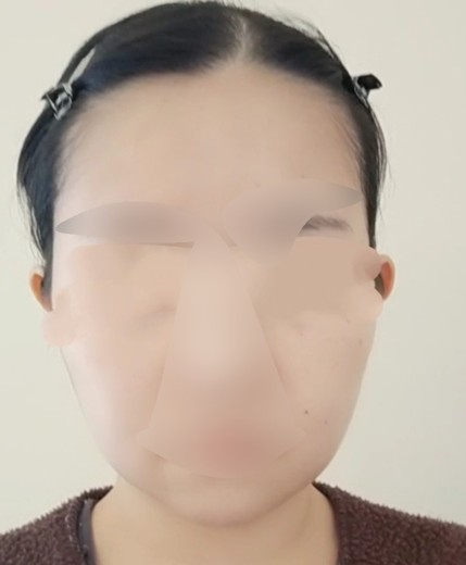 after photo: ウルトラセルQ+(ハイフ)