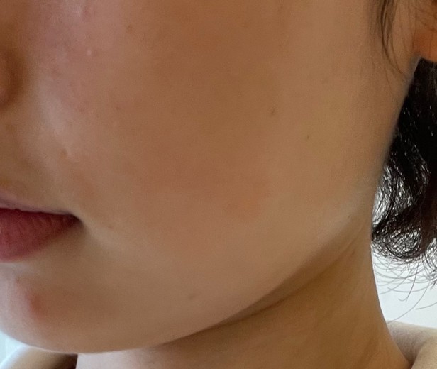 before photo: 사각턱보톡스, 튠라이너