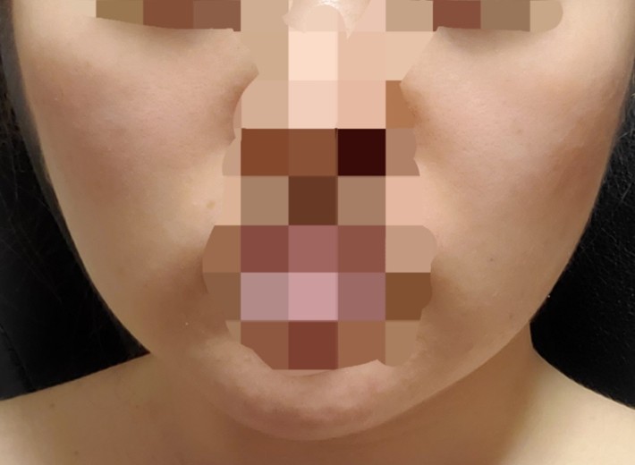after photo: 脂肪溶解注射(顔)