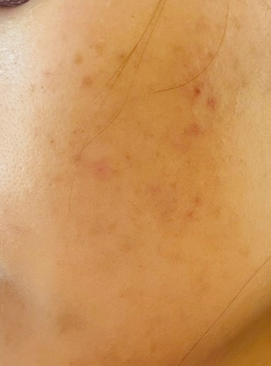 before photo: IPL(光/フォト治療), ピーリング, エレクトロポレーション